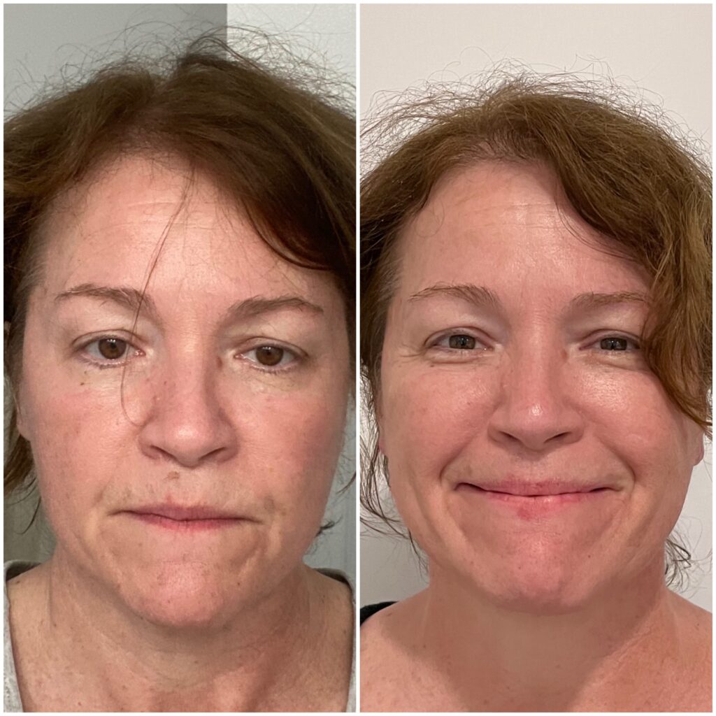 Before and after image from facial acupuncture treatments | Won Institute of Graduate Studies